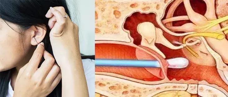 挖耳朵的注意事项有哪些,挖耳朵能经常挖吗