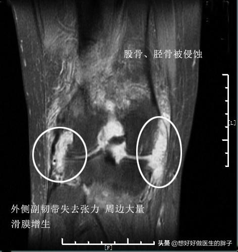 膝盖积水用烤灯能烤好吗?粗盐呢?医生:明确诊断针对治疗是关键