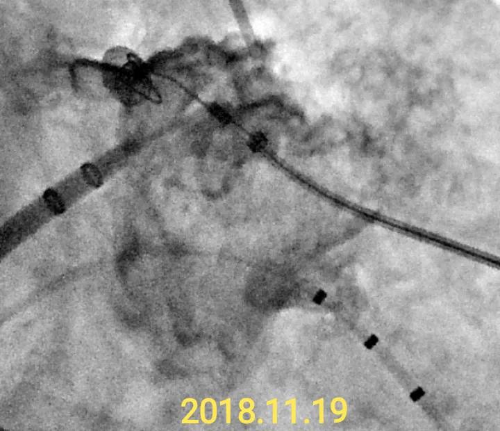 心血管病人吃伟哥,心血管病人可以用伟哥吗