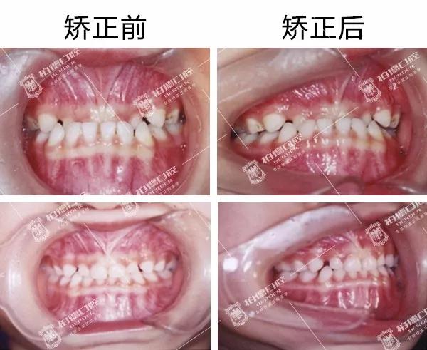儿童牙齿早期干预矫正有几种,儿童牙齿早期矫正图片