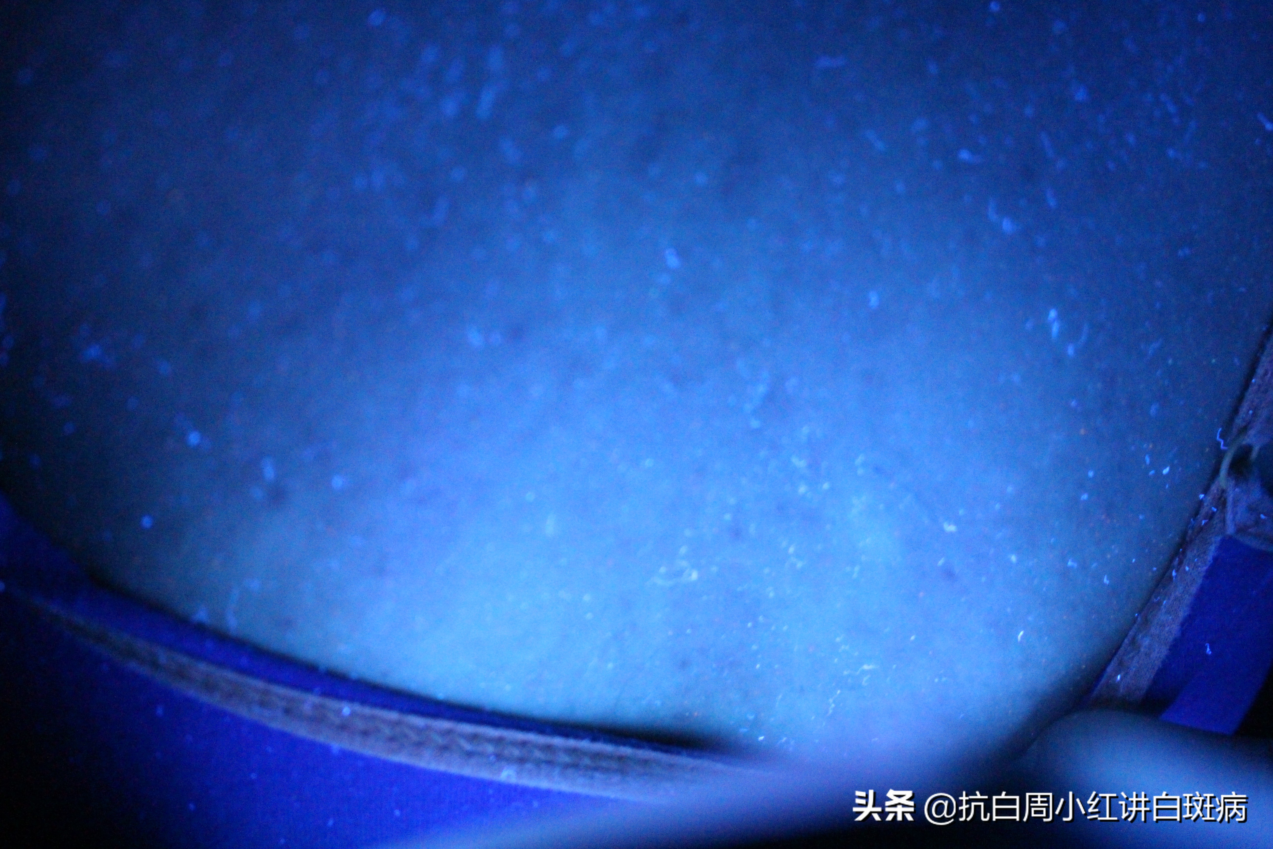 白癜风患者治好的全过程,白癜风治愈患者分享痊愈经验