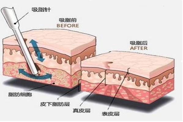女子抽脂手术后续,女子抽脂突然没了呼吸心跳