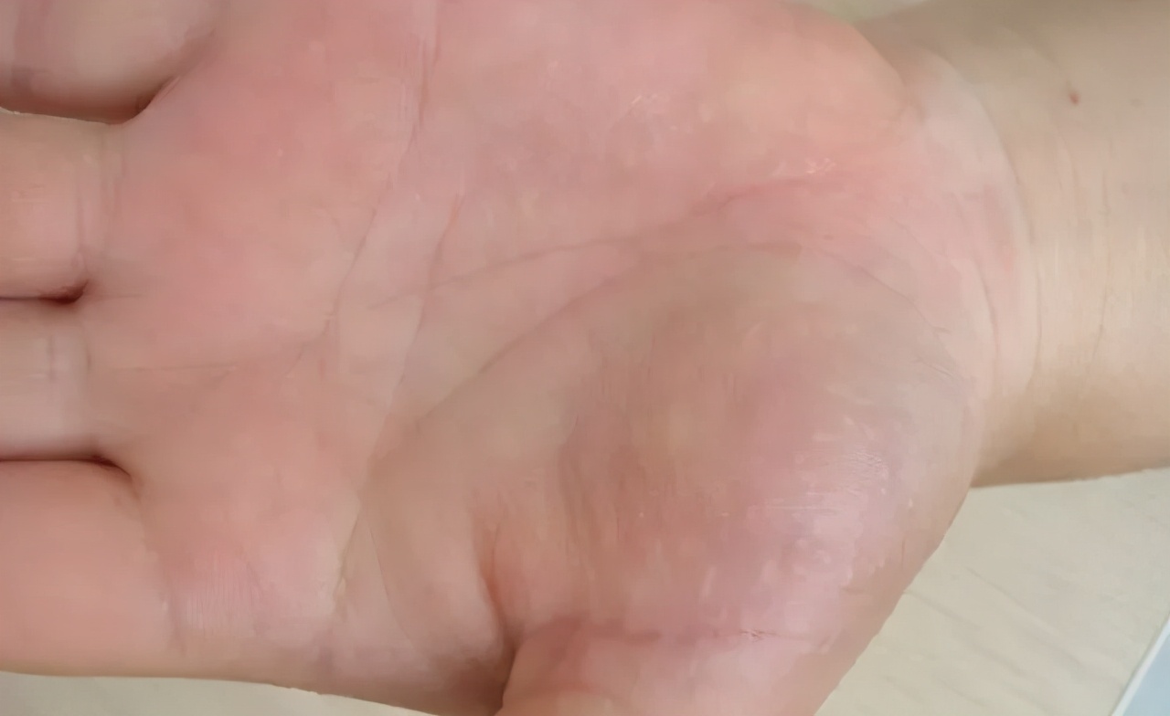 手上长汗疱疹痒在家怎么处理,手上出的汗疱疹水泡敢刺破吗