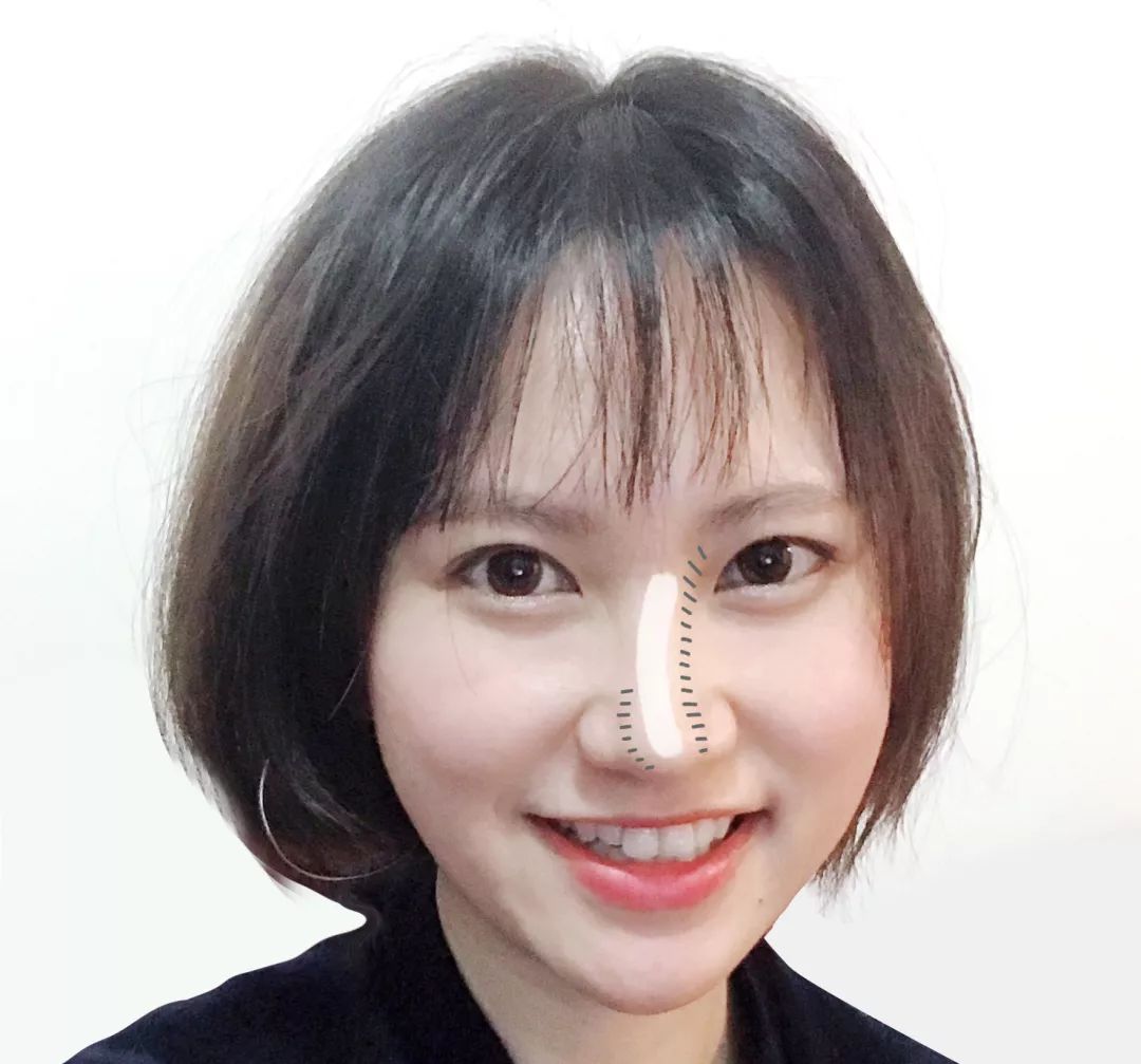 鼻型整容过程,如何缩鼻头鼻翼修容