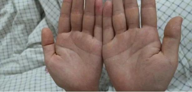 手汗症中医诊疗方案,手掌多汗症怎么治疗