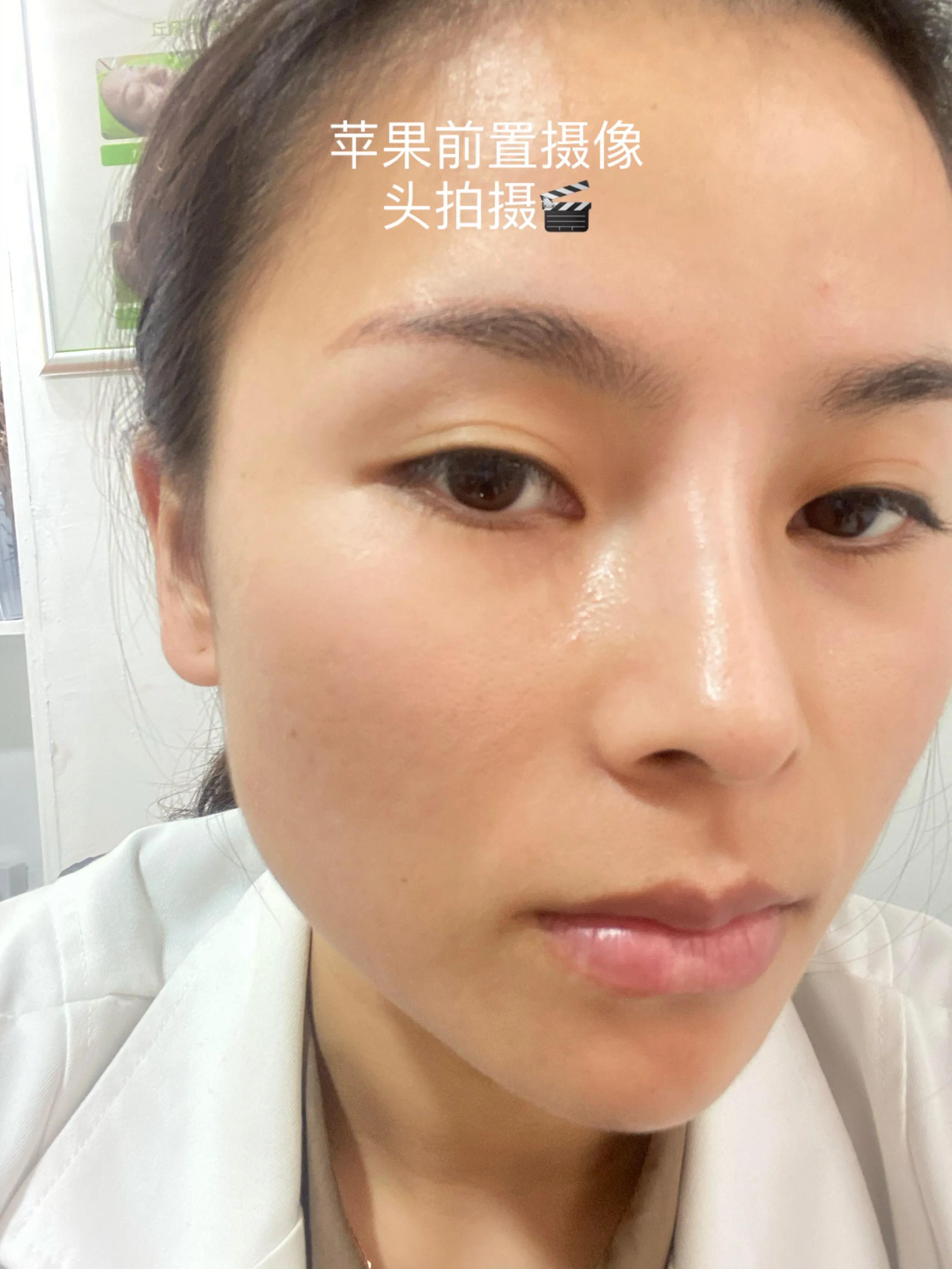 30天快速消痘印,30天祛痘效果最好的方法