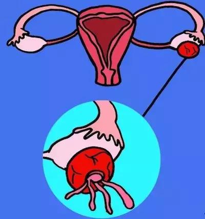 肚子疼腰疼是什么性质的卵巢囊肿,卵巢囊肿引起的肚子疼怎么回事