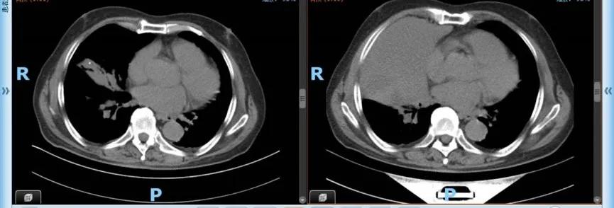 真实案例癌症晚期还能活15年,癌晚期活了15年案例
