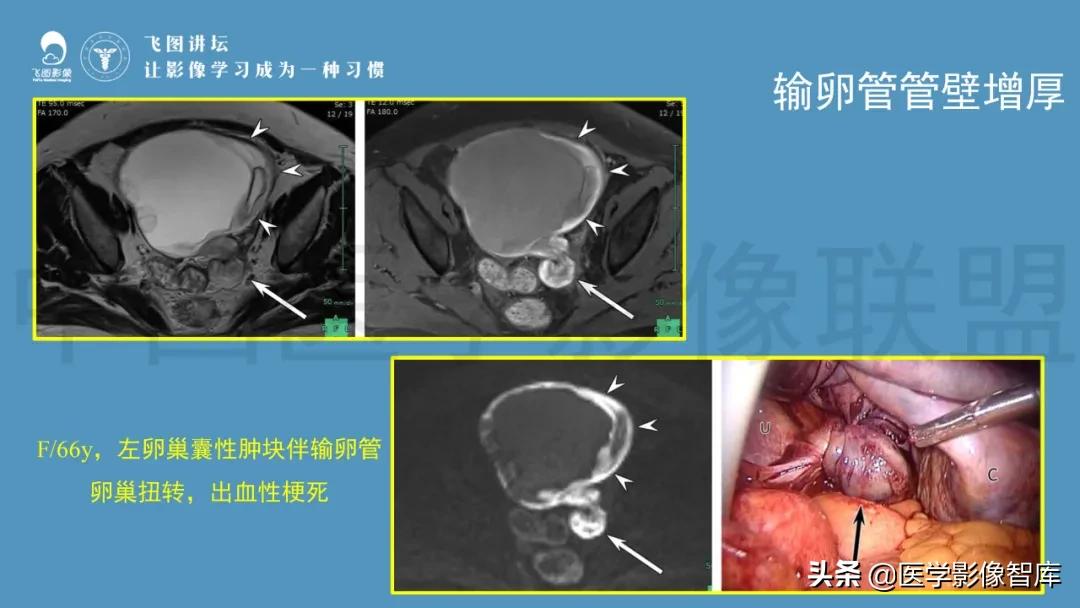 子宫解剖结构输卵管和卵巢位置,子宫附件ct影像学正常解剖表现