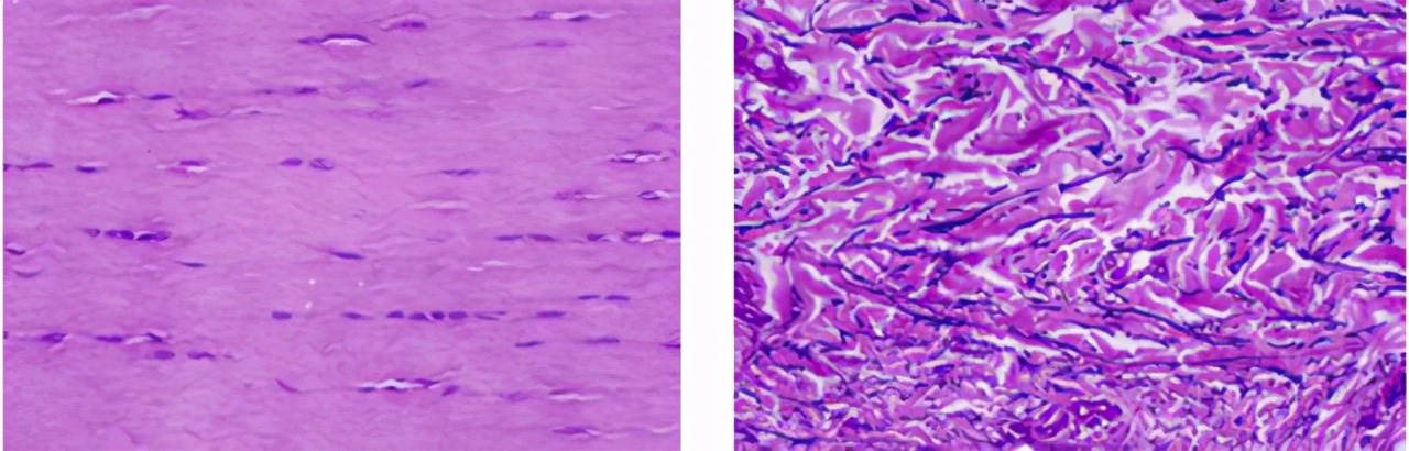 线雕吸收完了脸会变窄吗,做一次线雕代谢后会不会回到以前