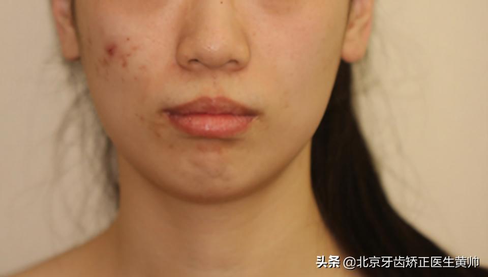 橡胶牙套矫正后脸型变化,戴过牙套的脸恢复了吗