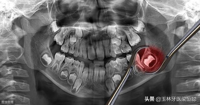 中医认为智齿需要拔除吗,正位智齿需要拔除吗