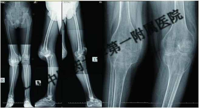 小伙子身患强直性脊柱炎自强不息,强直性脊柱炎康复后能干重活吗