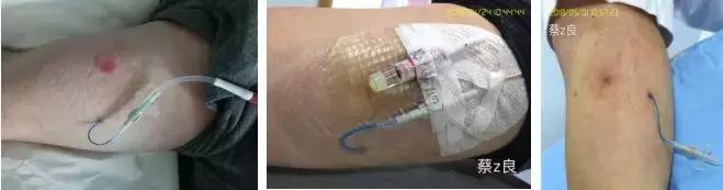 水泡破了如何处理,手掌水泡破了怎么处理