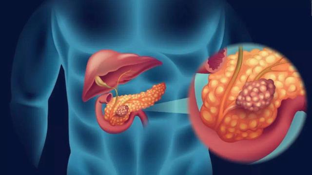 胰腺癌痛苦怎么办,胰腺癌病人心里难过