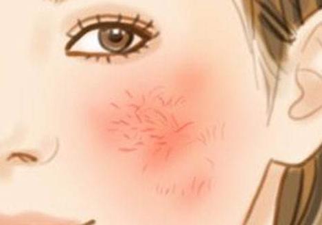科普祛除红血丝,红血丝科普医美