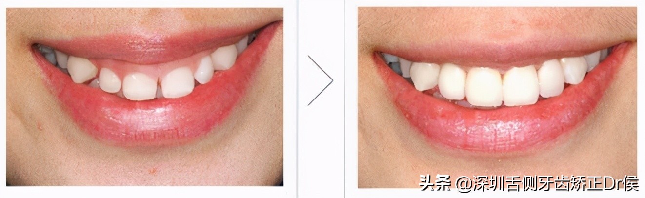 牙齿中间有黑色缝隙,牙齿有缝隙需要补吗