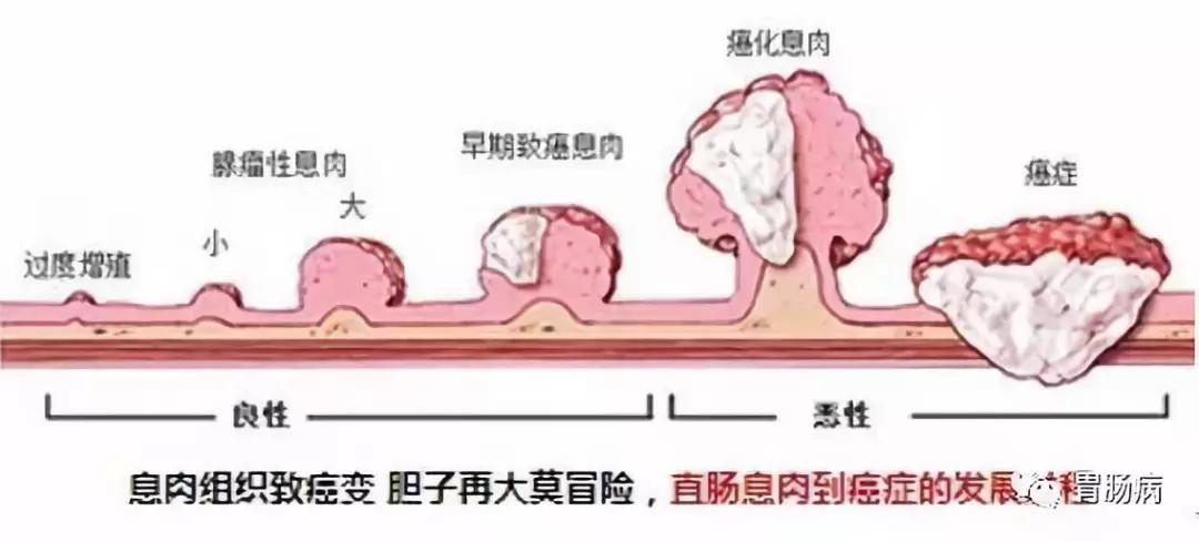 胆囊息肉19mmx10mm会变成癌不,息肉增生会不会变癌