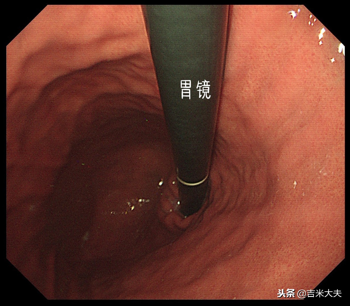 做完胃镜检查我的胃烂了一点,做完胃镜拿了报告怎么拿药