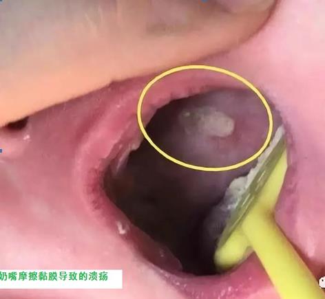 9岁孩子口腔溃疡怎么办,孩子反复口腔溃疡求良方