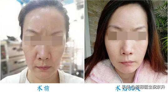 全脸线雕做完即刻提升效果不明显,做完线雕即刻效果不明显