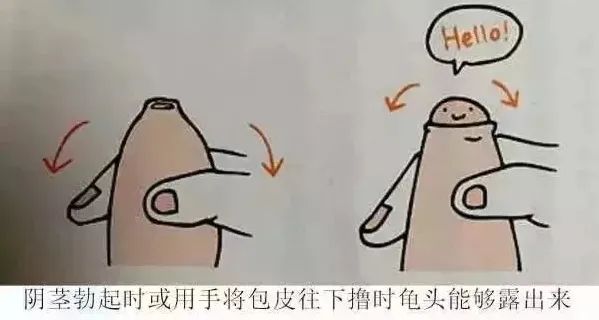 割包皮有第二根半价吗,割包皮有几率失误吗