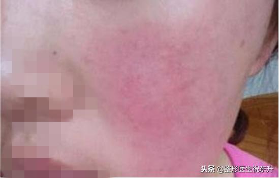 刚做完超声刀感觉脸有点肿正常吗,做完超声刀后脸肿了是正常现象吗