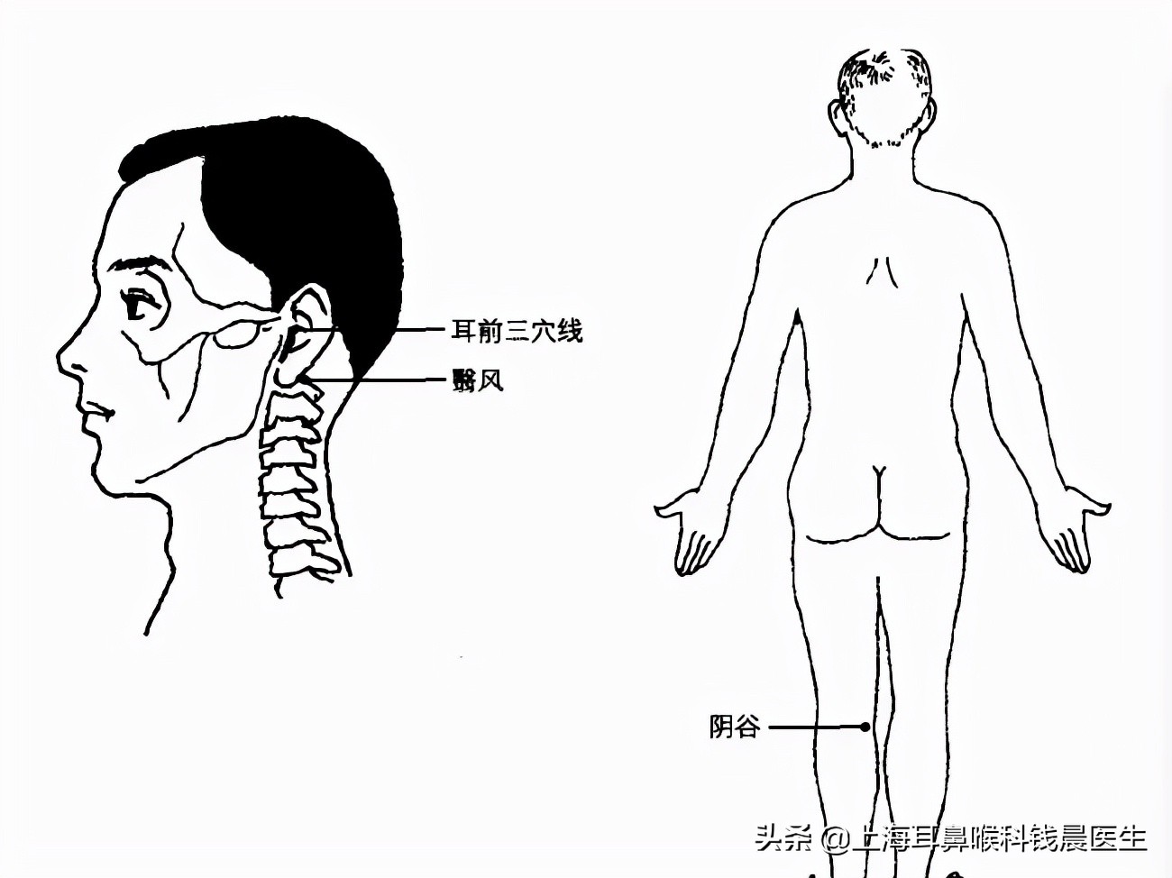 耳鸣艾灸最快的穴位,耳鸣艾灸什么穴位最见效