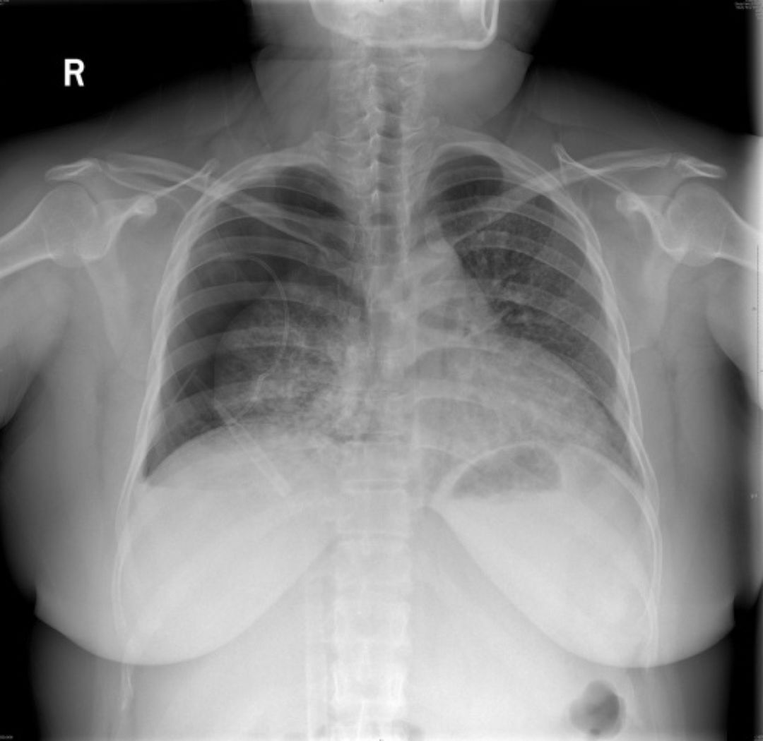 女性气胸的十大症状,女性气胸的十个表现