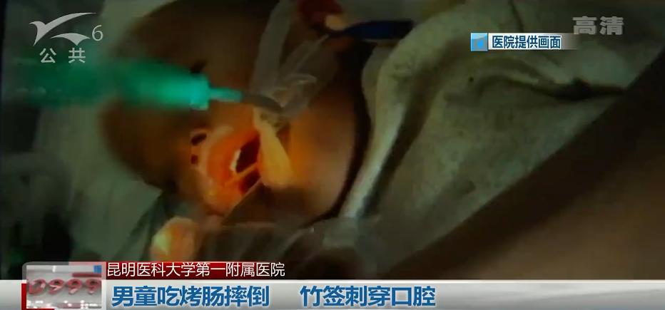 吃烤肠被竹签刺穿咽喉，医生：如果再刺深一点，孩子可能就当场死亡了