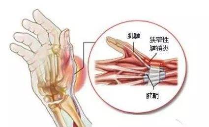 医生,我的手指为什么伸不直了