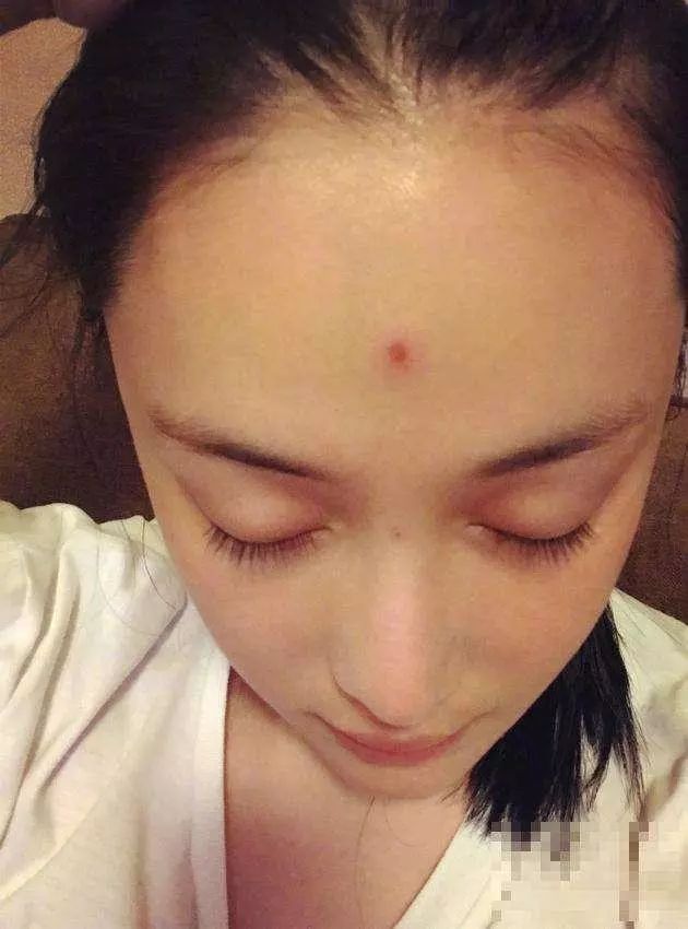 女星熬夜脸部痤疮,痘痘比较多的女明星