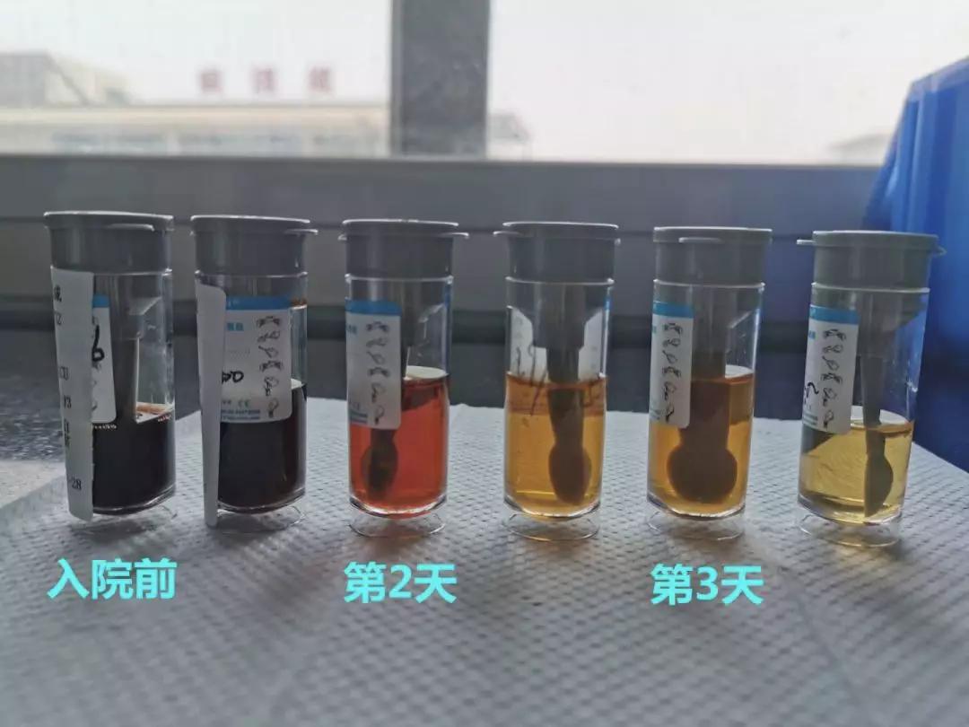 三岁宝宝高烧后尿茶色,疫情期间3岁宝宝高烧不退