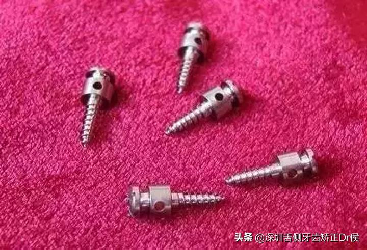 牙齿矫正神器价格,牙齿矫正支撑钉图片