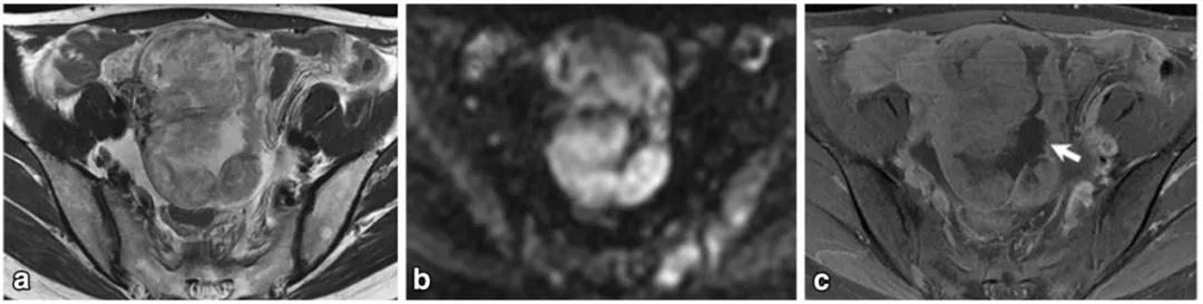 卵巢实性为主肿瘤，这13种你都想到了吗？