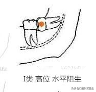 智齿分轻重嘛,智齿水平和非水平的区别