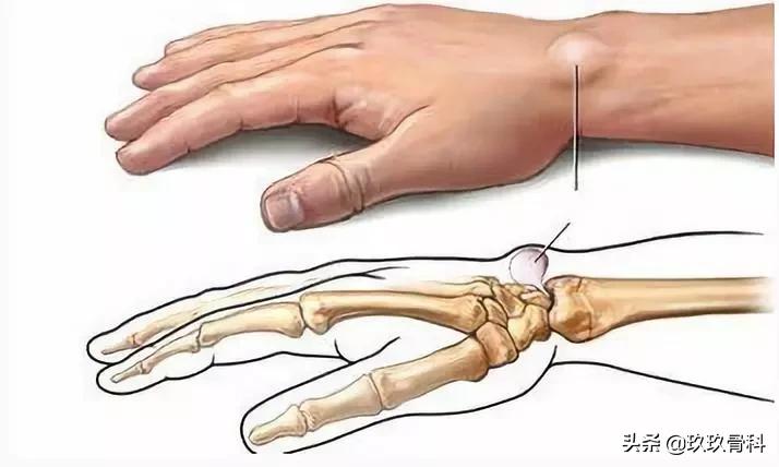 腱鞘囊肿针刺技巧视频,手指腱鞘囊肿正确挤压方法视频