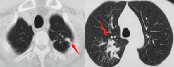 5个小故事：肺结核、脑梗死、车祸，这些意外发现的肺癌都能治