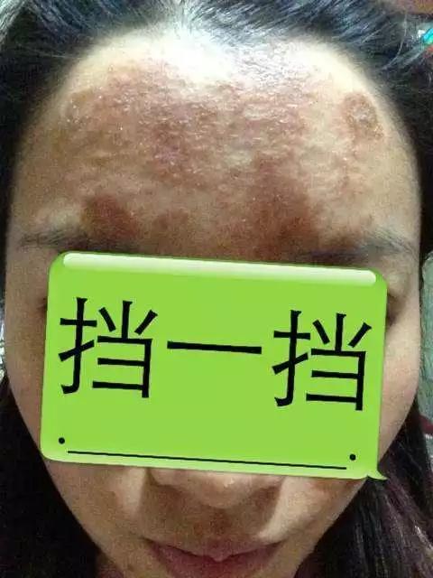 长期使用激素面膜的危害,面膜烂脸