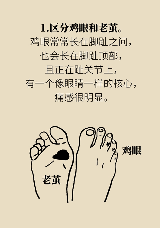 长了鸡眼该怎么办四大妙招教给你,长了鸡眼怎么治疗好得快