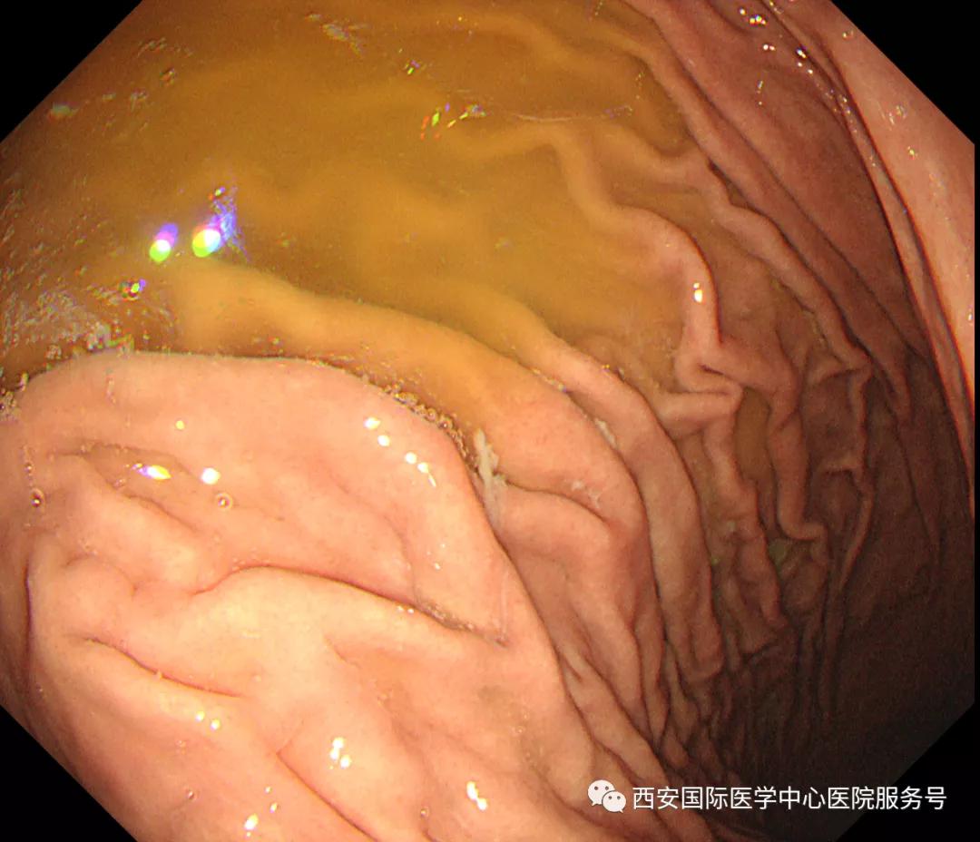 咳嗽不止很是难受,咳嗽不止容易犯呕