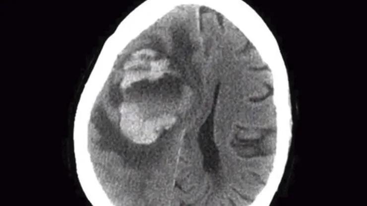 洗鼻生理盐水可以用自来水配吗,可以用自来水烧开兑洗鼻盐洗鼻吗