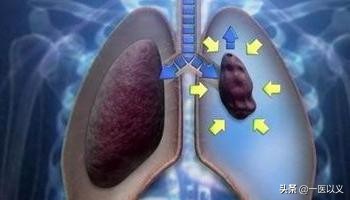 肺气肿慢阻肺最佳治疗方案,慢阻肺肺气肿稳定期怎么治疗