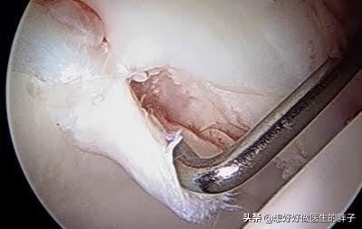 髋关节疼痛会引起腿痛吗,髋关节疼痛两腿不一样长如何康复