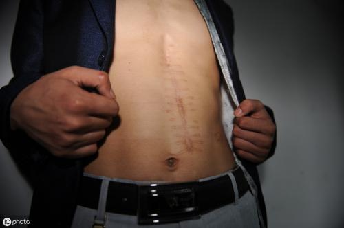 多大的肾结石需要做手术?除了多喝水,这些方法也能帮助排出结石