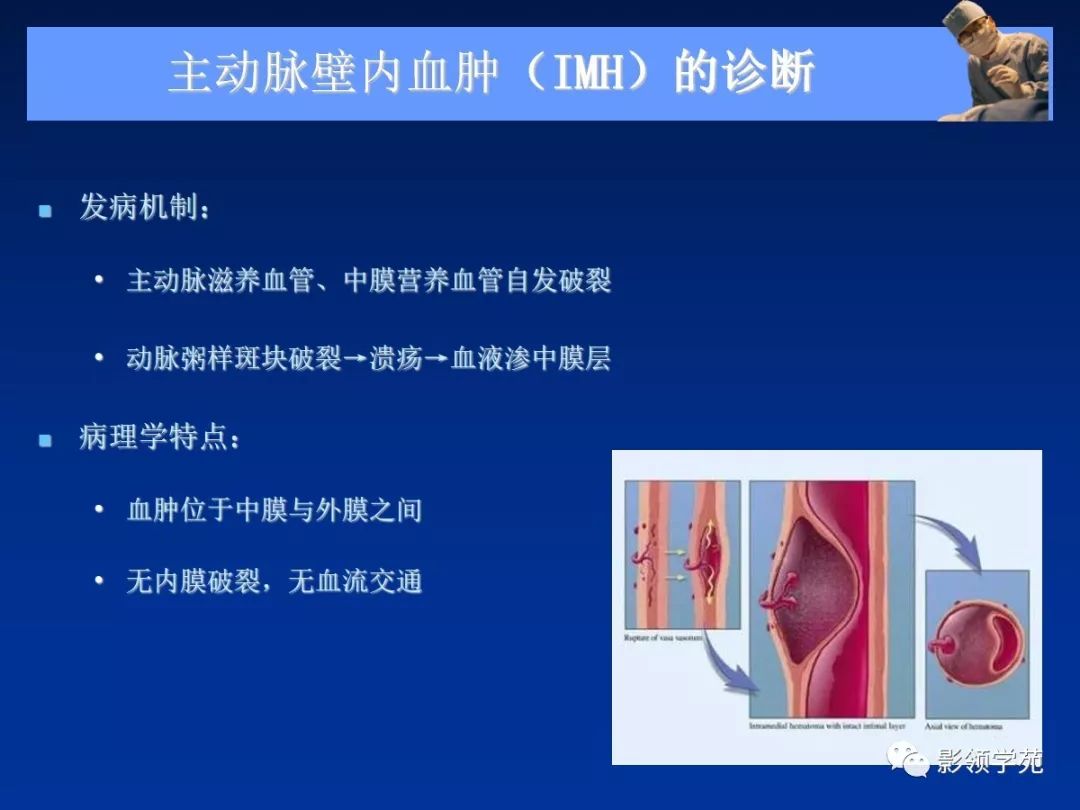 主动脉夹层壁间血肿如何鉴别,主动脉夹层血肿溃疡
