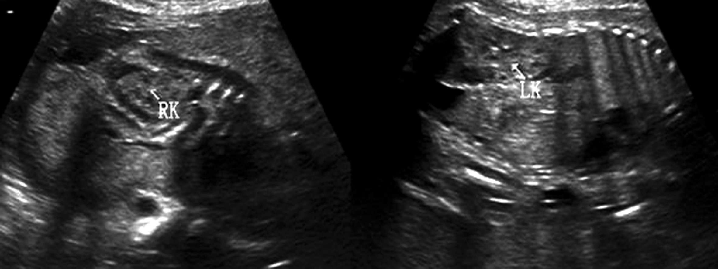 孕期不能忽视的胎儿超声检查,胎儿超声检查报告表