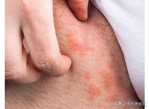 男性根部潮湿瘙痒用什么药,男性腿两侧根部瘙痒用什么膏药