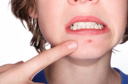 脸上长痘痘位置与器官,脸上不同位置长痘痘的原因