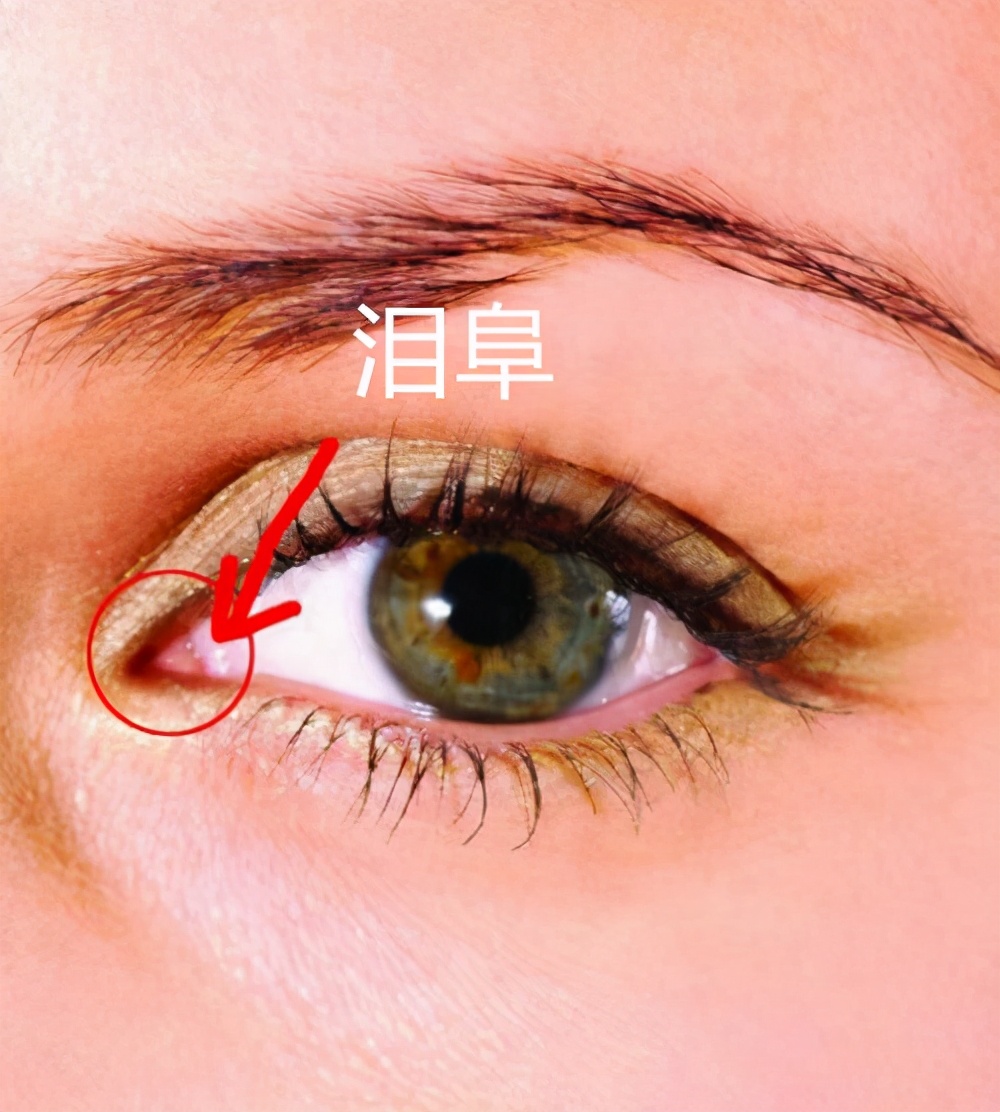 开眼角过大图片,开眼角过大修复效果图